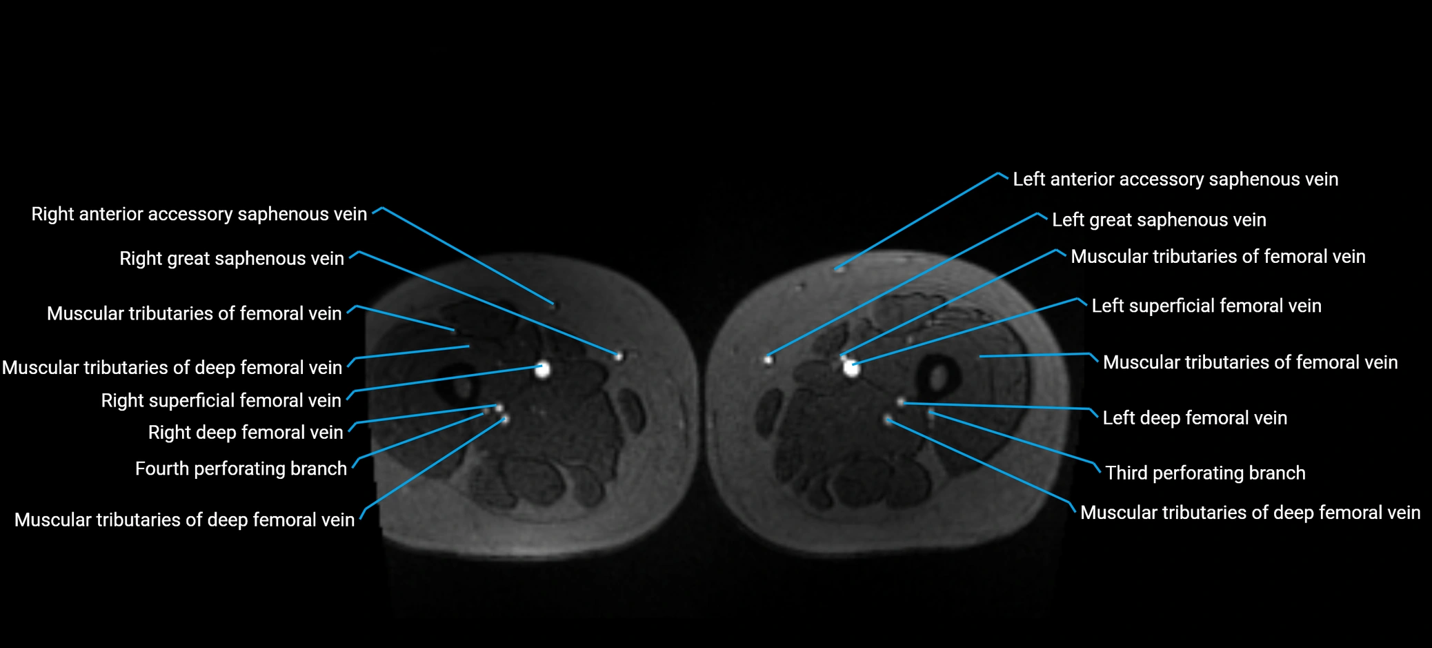 MRV abdomen pelvis & lower limb axial cross sectional anatomy labelled MRI image 258 (1).webp